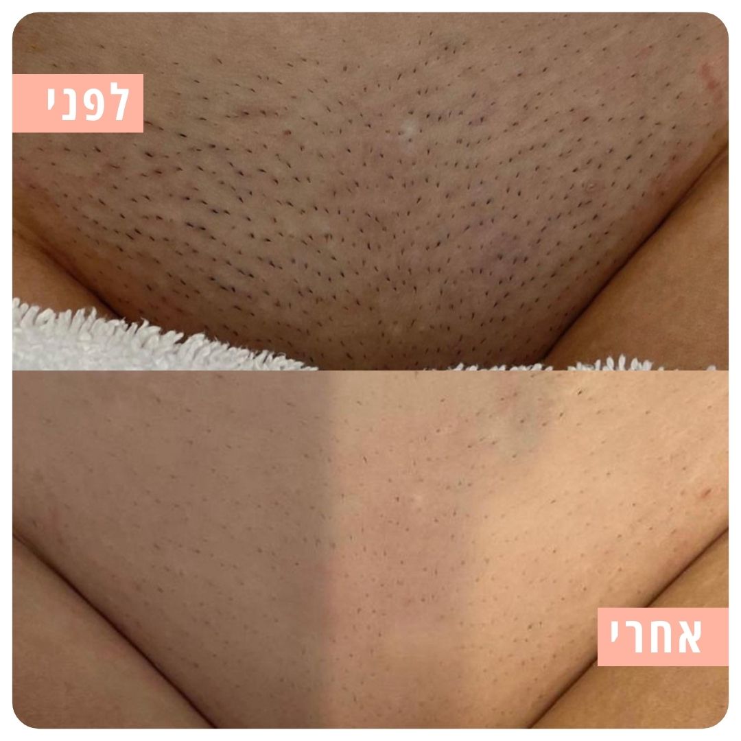 Myne - ערכת גילוח בטיחותית למניעת גירוי וחתכים