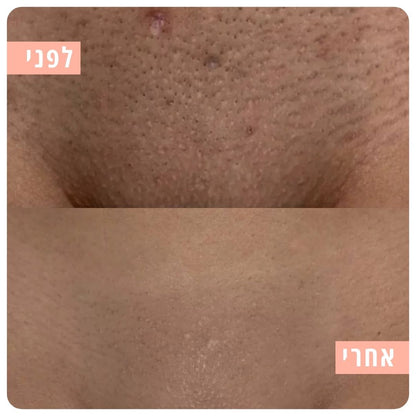 Myne - ערכת גילוח בטיחותית למניעת גירוי וחתכים